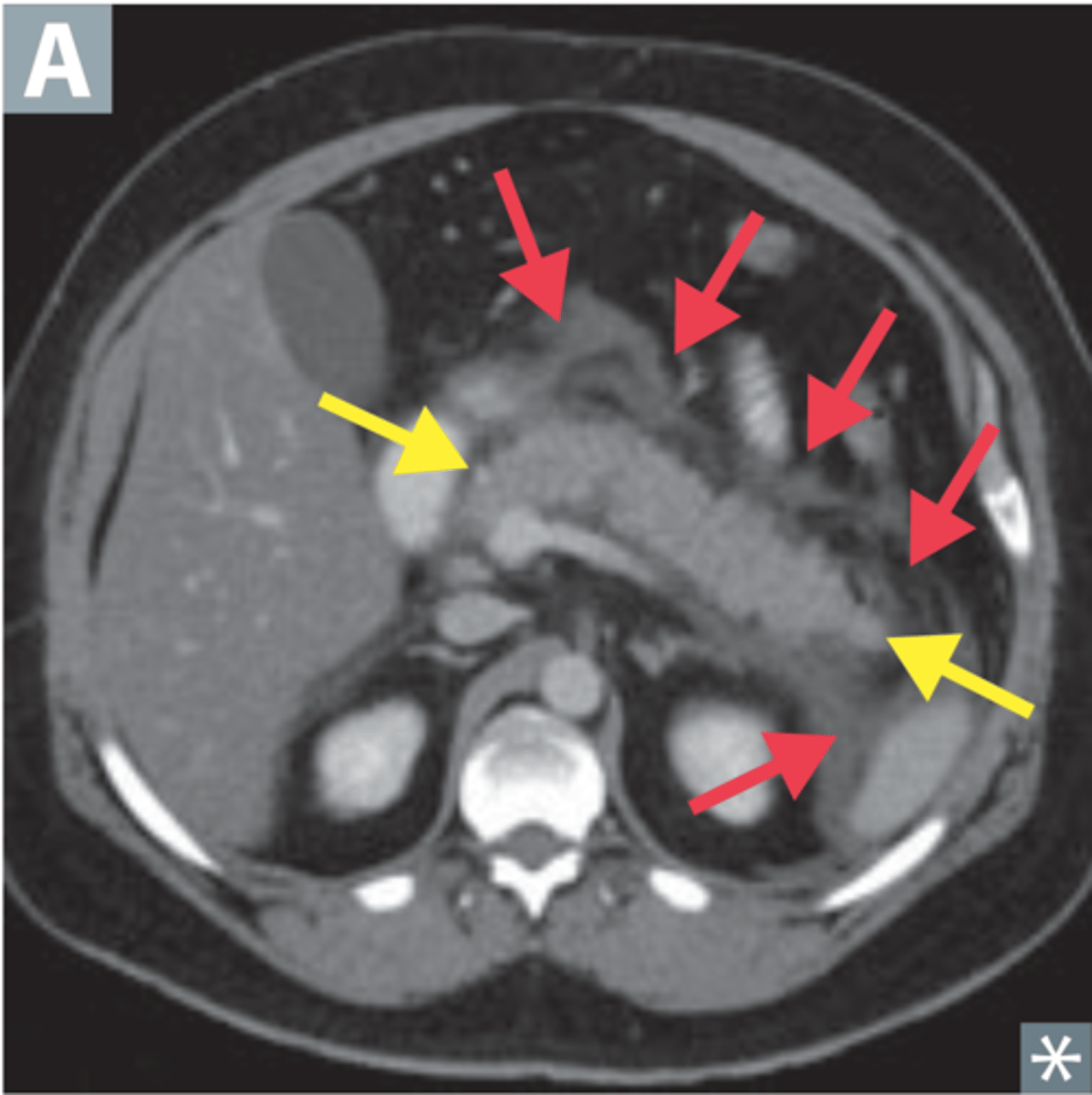 <p>may appear enlarged and irregular, infiltration of peripancreatic fat, fluid surrounding</p>