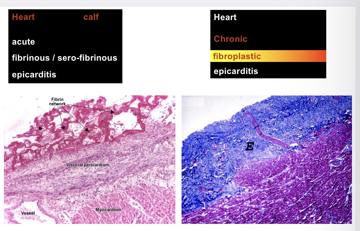 <p>traumatic reticulopericarditis (fibrino-suppurative pericarditis) / wire hardware disease Histo </p>