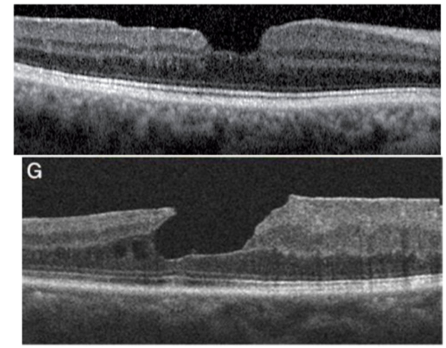 <p>irregular foveal contour and atrophy of inner retinal layers, with intact outer retinal layers (like PR's)</p>