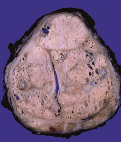 <p>benign prostatic hyperplasia (BPH)</p>