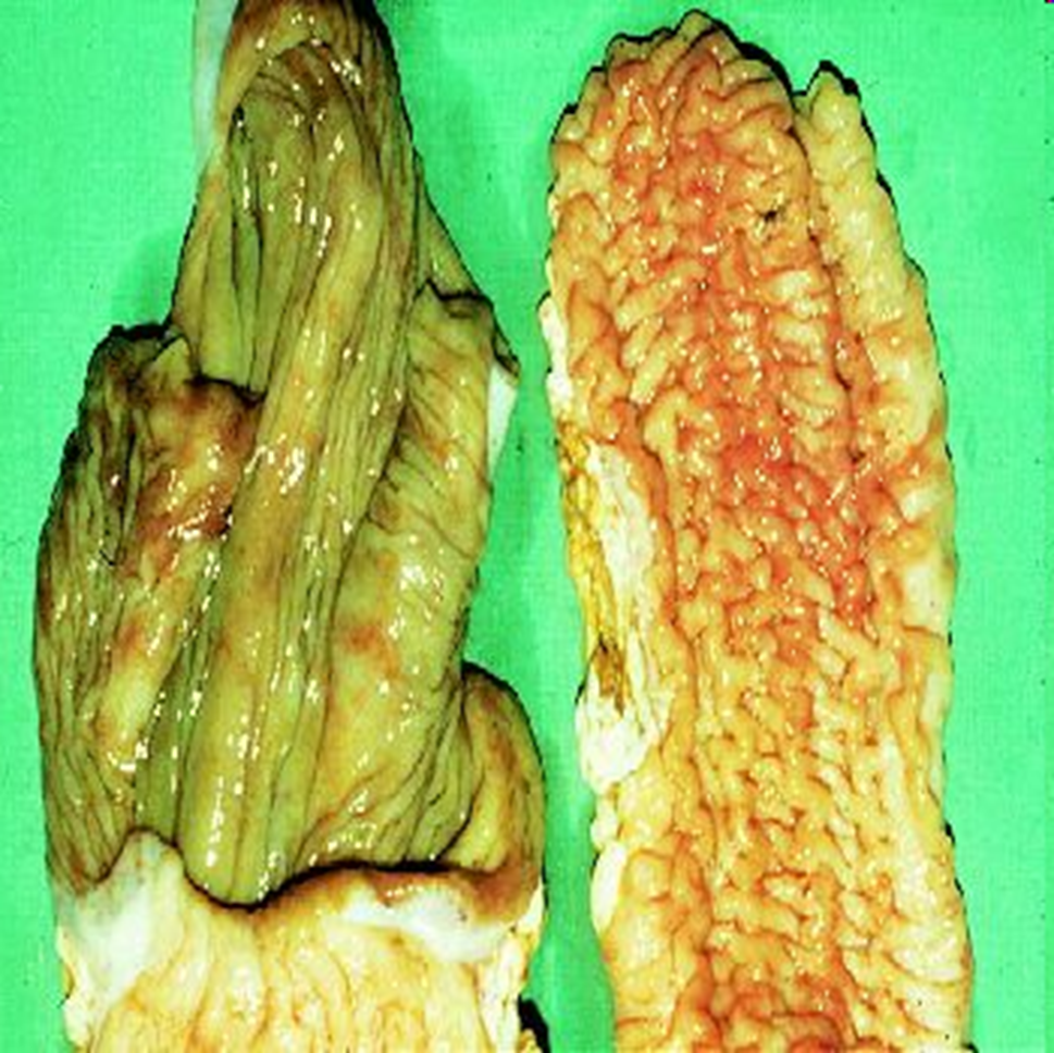 <p>What organ is this? Give a morphological description, morphological diagnosis, disease diagnosis, and etiology</p>