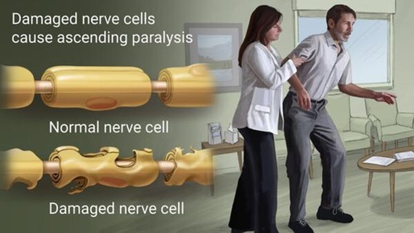 <p>PNS</p><p>inflammation of the peripheral nerves where myelin sheaths on axons are destroyed, resulting in decreased nerve impulses, loss of reflex response, and sudden muscle weakness</p><p>- attacks schwann cells</p><p>- occurs after viral infection</p><p>- acute</p><p>- autoimmune</p>