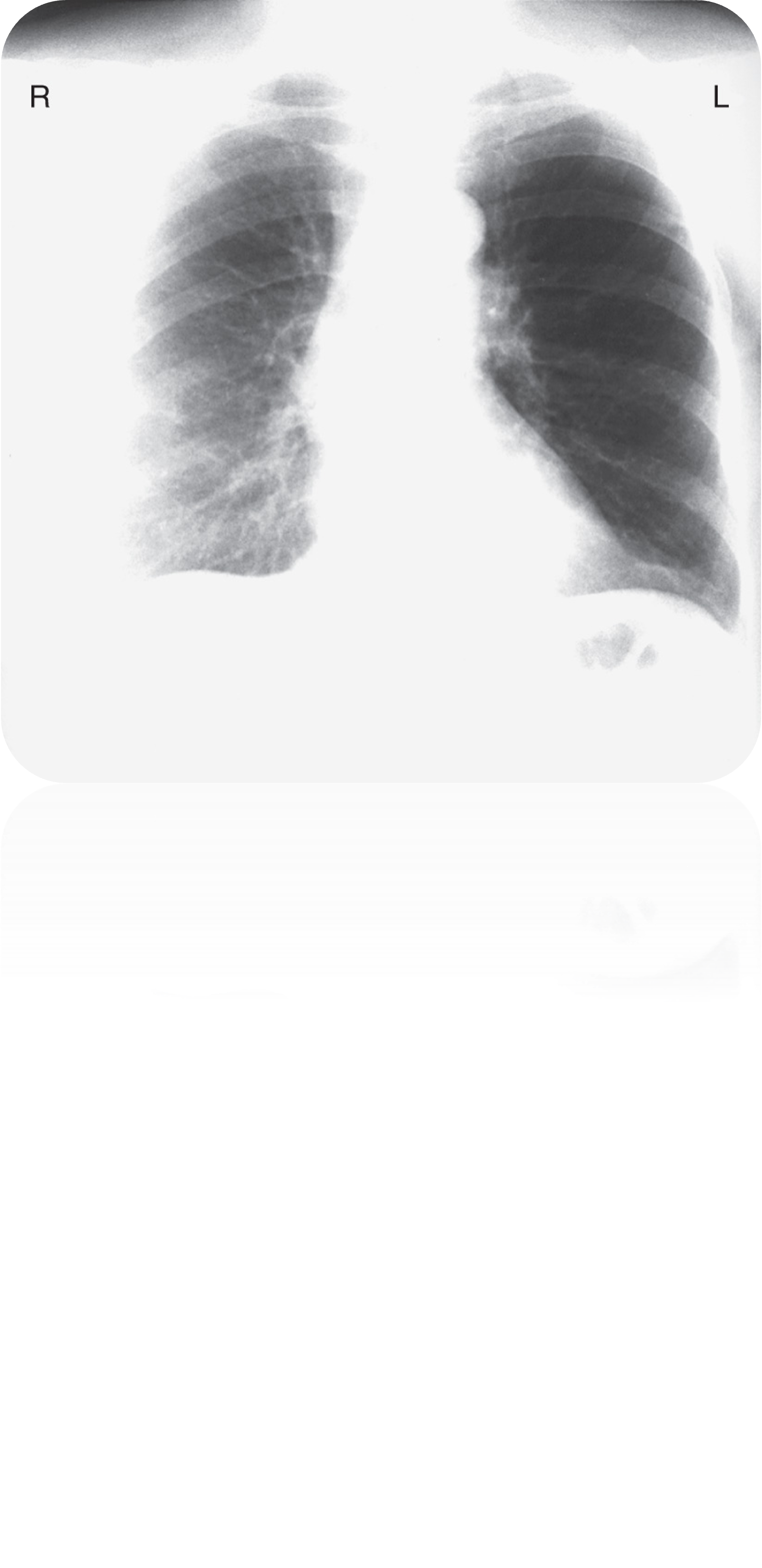 <p>This patient has a history of left mastectomy; what should you be cautious about when interpreting this CXR?</p>