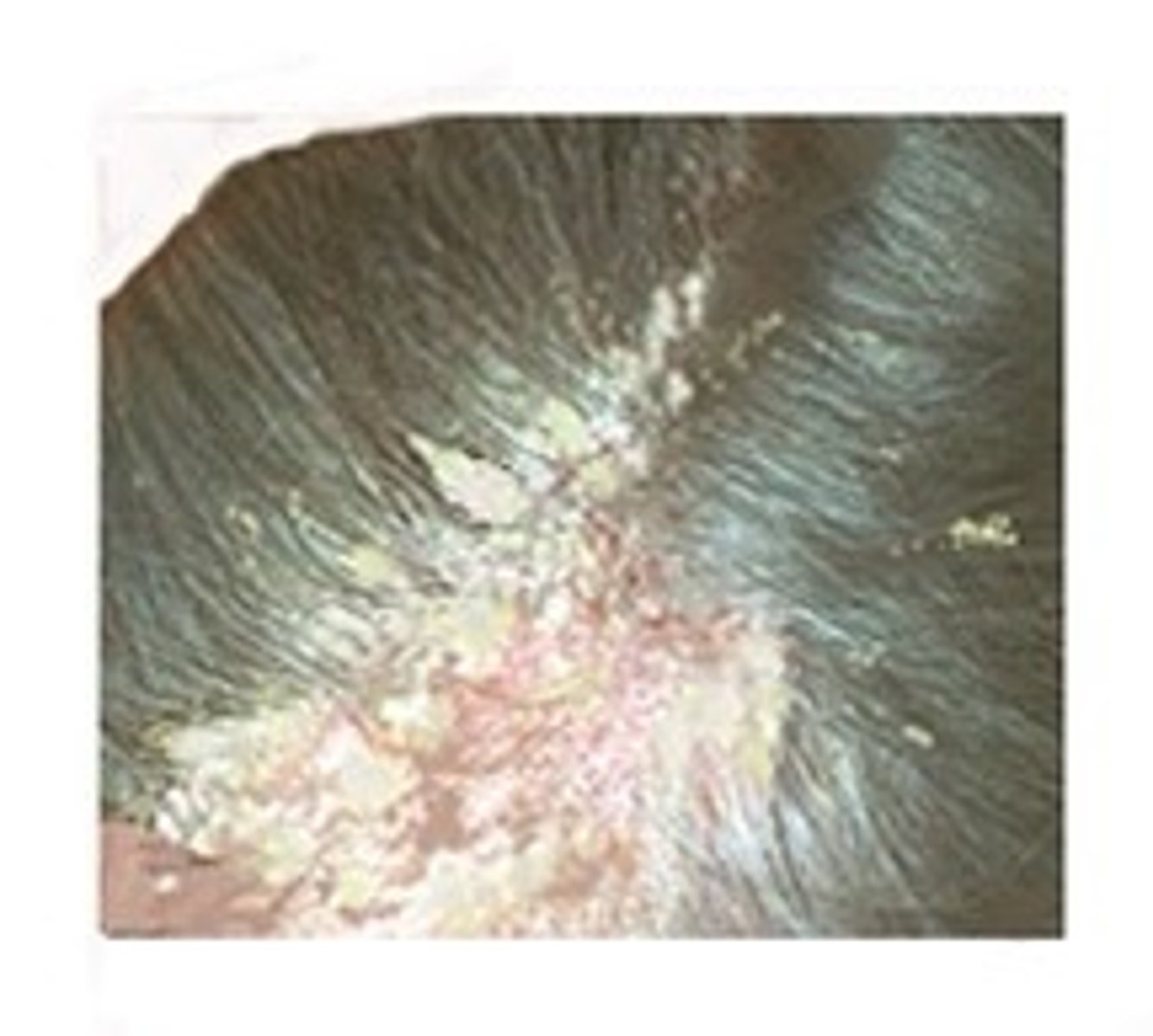 <p>severe case of dandruff characterized by an accumulation of greasy or waxy scales mixed wth sebum, that stick to the scalp in crusts.</p>