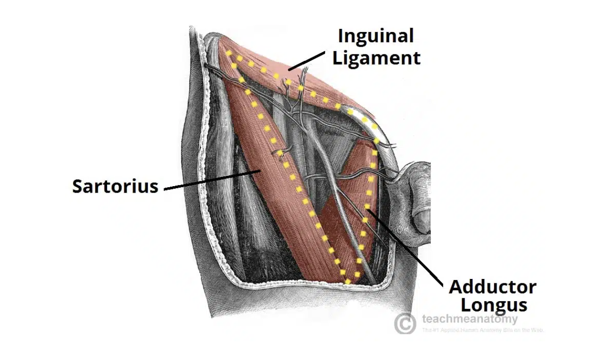 <ul><li><p><strong>Base</strong>: inguinal ligament</p></li><li><p><strong>Medial border</strong>: adductor longus</p></li><li><p><strong>Lateral borde</strong>r: sartorius</p></li><li><p><strong>Floor</strong>: iliopsoas, pectineus, adductor longus</p></li><li><p><strong>Apex</strong>: continual with adductor canal that descends medially and through the adductor hiatus</p></li></ul><p></p>