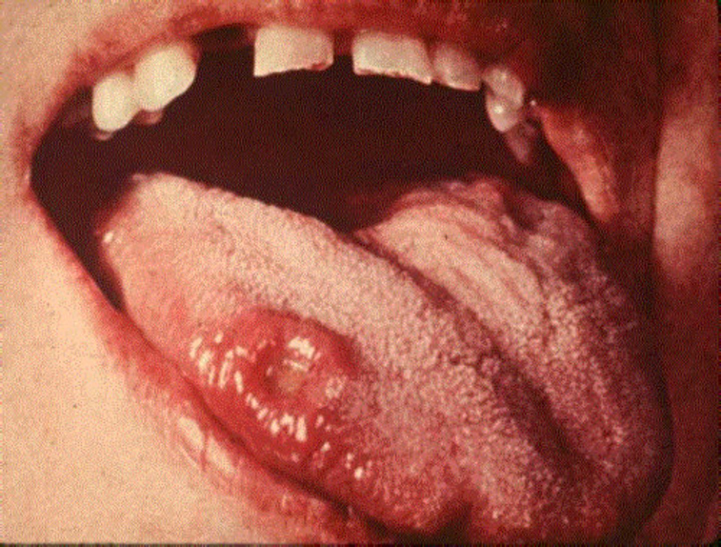 <p>usually round, small, painless</p>