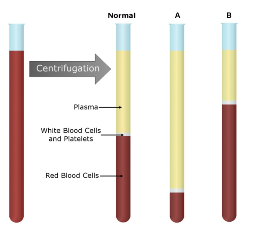 <p>the tube labeled “B“ is most consistent with</p>