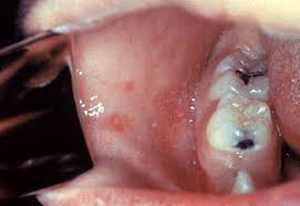 <p>associated with measles (rubeola)</p><p>small white specks on red background</p><p>on buccal mucosa→near 1st+2nd molars</p>