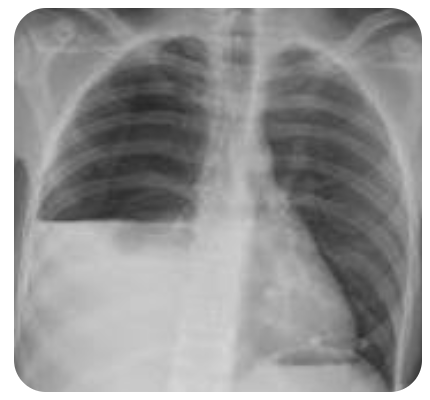 <p>A mixture of blood and air in the pleural space that leads to HYPOresonance over gravity dependent blood and HYPERresonance over superior air filled space that can progress to a tension pnuemo</p>