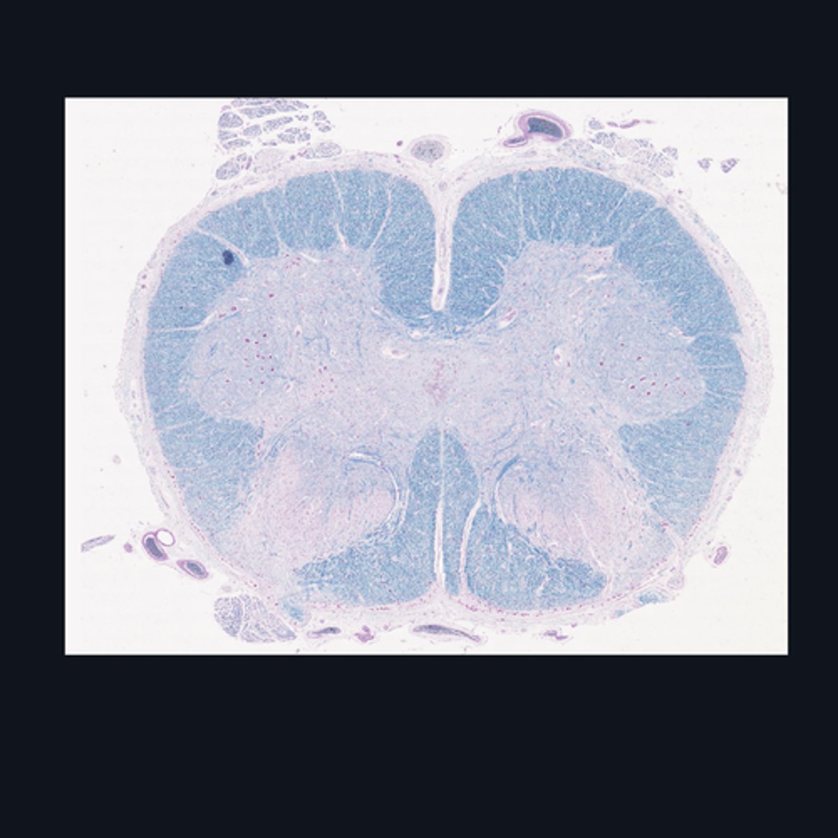 <p>T or F: The white matter in this region of the spinal cord is larger than the white matter in the thoracic region of the spinal cord.</p>
