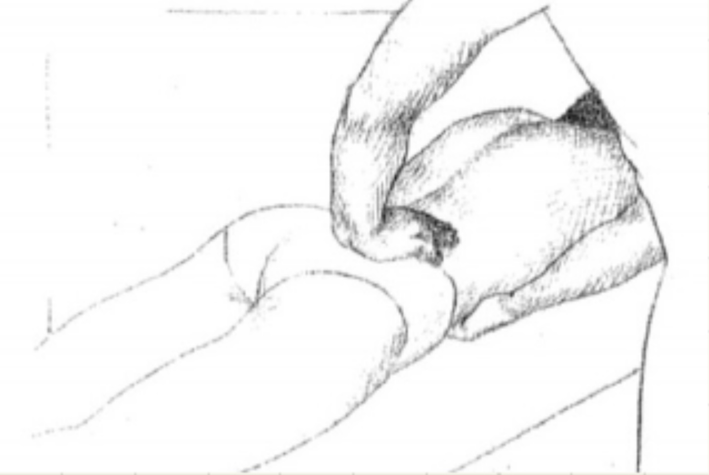 <p>El enfermo se coloca en decúbito prono.</p><p>La mano abdominal provoca impulsos, los cuales son percibidos por la mano lumbar, al tiempo que se va sobre elevar el ángulo costolumbar.</p><p>Se busca evaluar tumor extrarenal adherido al riñón o tumor abdominal. No renal en relación a la pared posterior.</p>