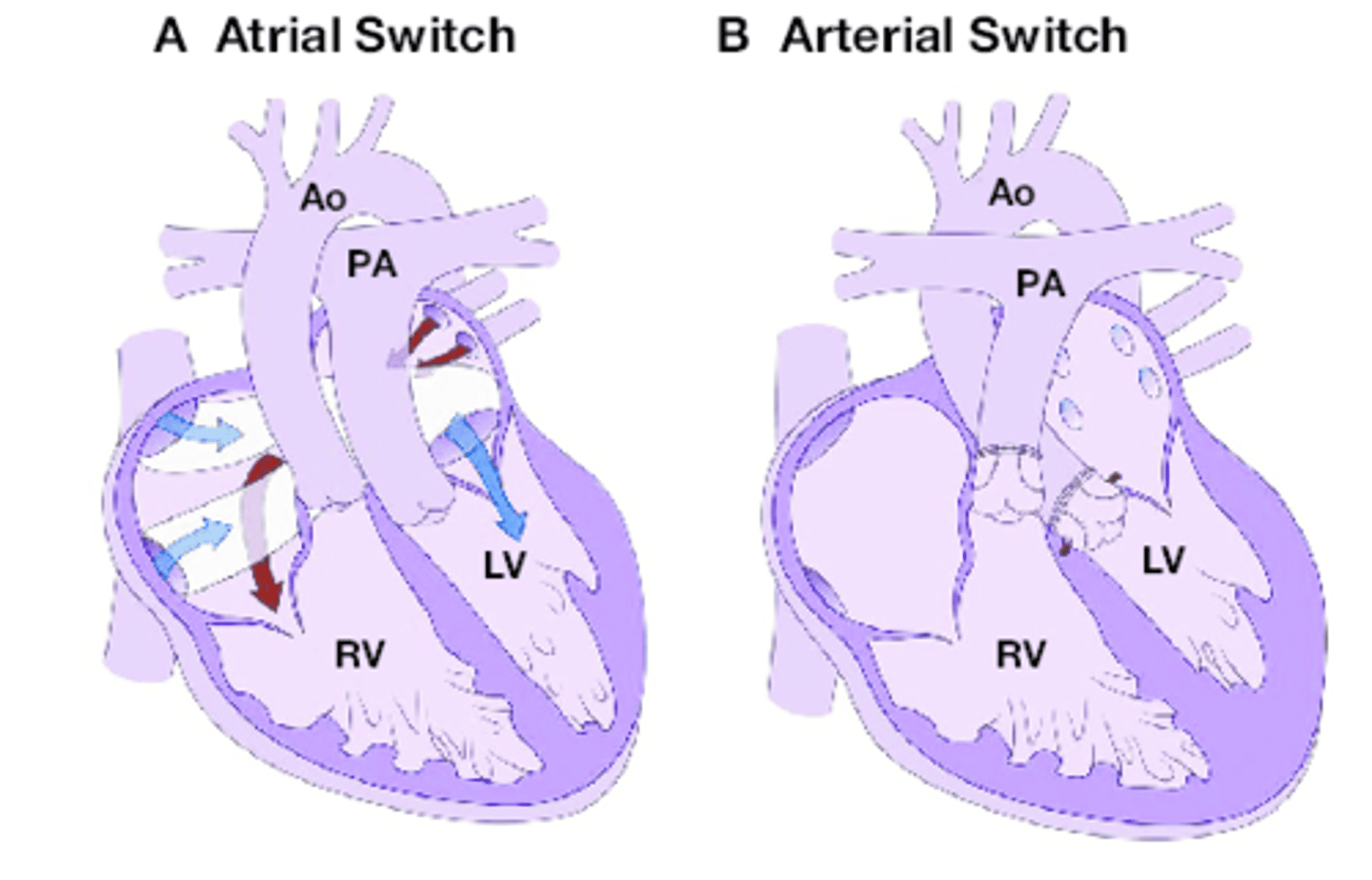 <p>higher rates of arrhythmias and ventricular dysfunction (30-40%) at 10 years.</p>