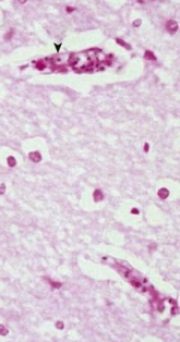 <p>8.3 Side B (PBD9: 390; BP9: 418)<br></p>
<p><br></p>
<p>Questions<br></p>
<p>A 7-year-old Nigerian girl with fever and chills dies with cerebral edema. Her cerebral cortex is shown.<br></p>
<p><br></p>
<p>1. What is causing her cerebral edema?<br></p>
<p>2. What are the less virulent species of this parasite?<br></p>
<p>3. What imparts resistance to this organism?<br></p>