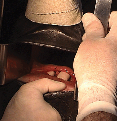 <p>What this?</p><p>Aetiopathogenesis?</p><p>Sx time?</p><p>Pre and post op tx?</p>
