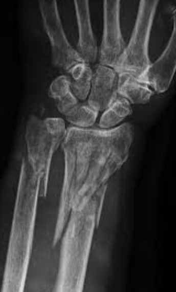 <p>What type of fracture is this? (Bonus points for full explanation)</p>