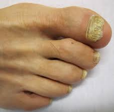 <p>PP: fungal infection of nails</p><p>E: dermatophytes</p><p>CM: subungual hyperkeratosis<br>scaling<br>yellow discoloration<br>onycholysis (end of nail lifts up)</p><p>DX: clinical<br>KOH<br>culture<br>nail plate biopsy</p><p>TX:<br>topical ciclopirox QD x 1 year<br>terbinafine QD x 3 months<br>-mx interactions<br>-mtr liver enzymes</p>