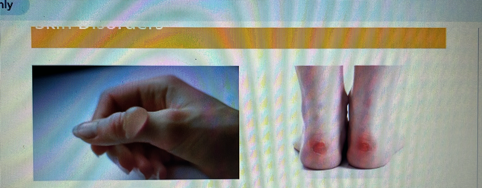 <p>SKIN DISORDER</p><p></p>