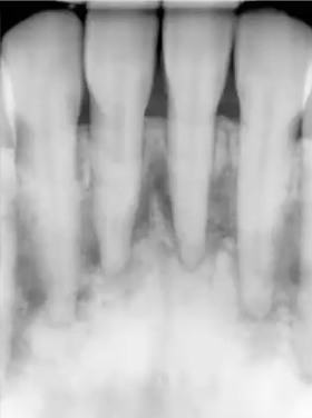 <p><strong>middle aged black female</strong> presents with these incidental findings on a pa, teeth are vital, diagnosis?</p>