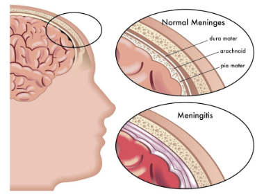 <ul><li><p><strong>Meningitis</strong>: <span style="color: red"><strong>Inflammation of the meninges </strong></span></p><ul><li><p>May spread to CNS → which would lead to <strong>inflammation of the brain → encephalitis </strong></p></li></ul></li><li><p>Meningitis is usually diagnosed by observing microbes in sample of CSF obtained via lumbar puncture </p></li></ul><p></p>