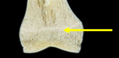 <p>A remnant of the growth plate in a long bone that represents the fusion of the epiphysis and diaphysis once growth has ceased. </p>