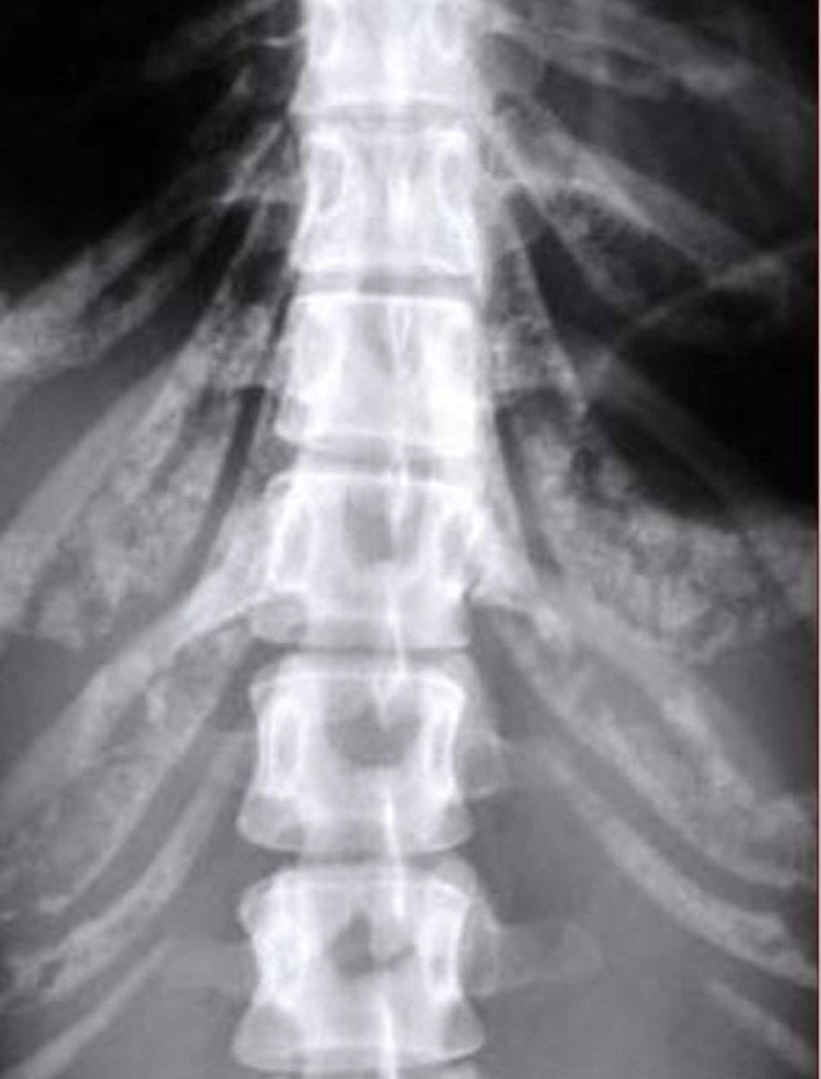 <p>More common in lower ribs</p>