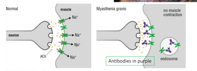 <p>What is this disease</p>