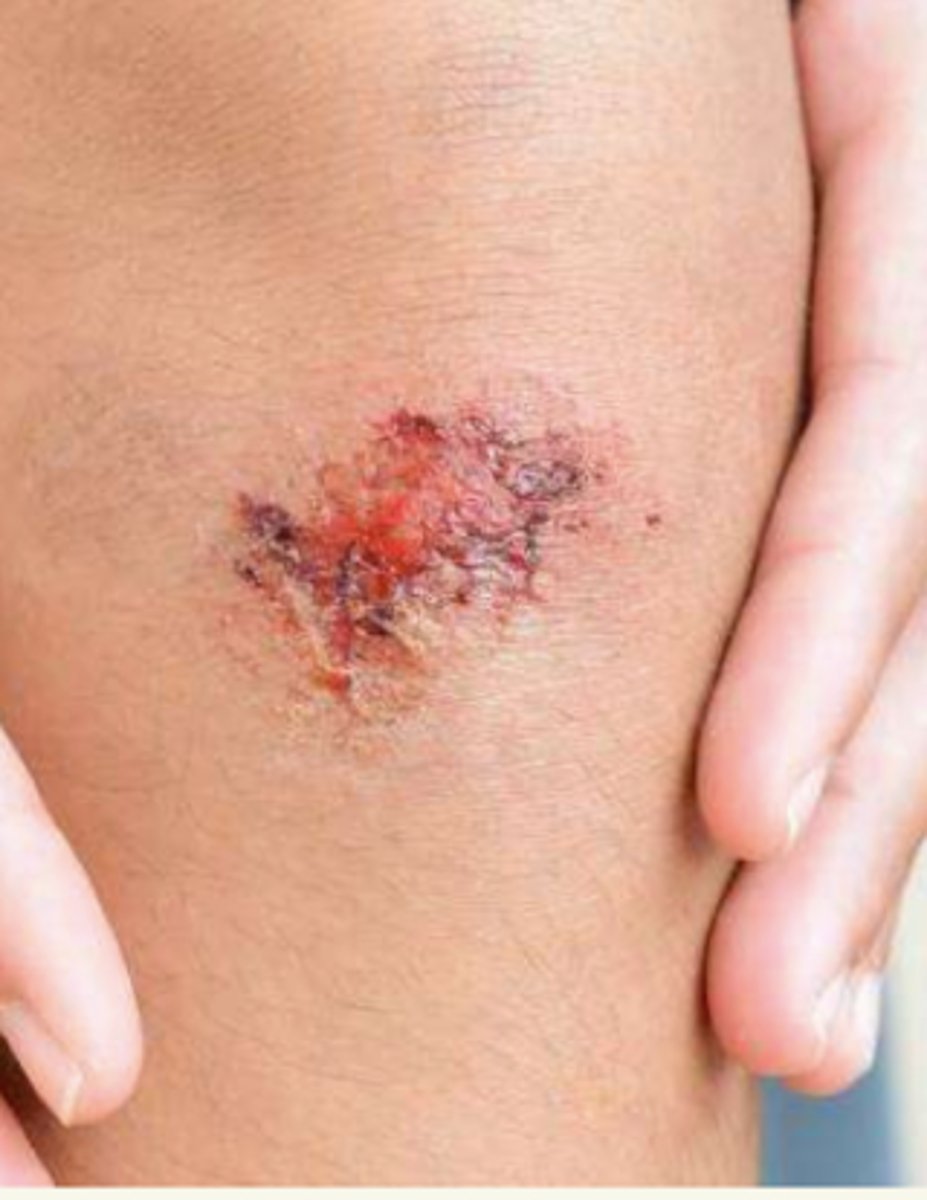 <p>¿lesión?</p><p>¿primaria o secundaria?</p>