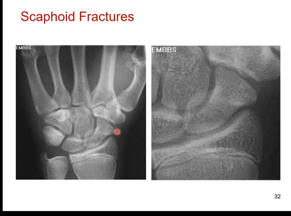<p>Yes scaphoid bone has poor blood supply. it takes a long time to heal cause it gets only a little bit of oxygen</p>