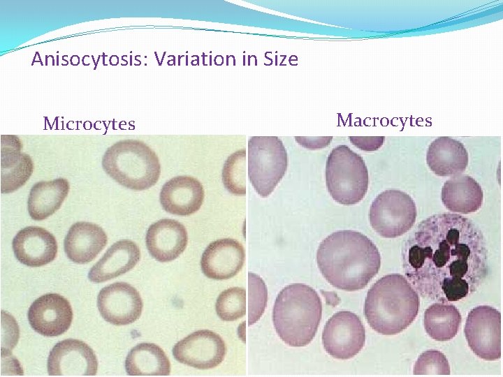 <ul><li><p>Macrocytosis - Larger than normal RBCs </p></li><li><p>Microcytosis - Smaller than normal RBCs </p></li></ul><p></p>