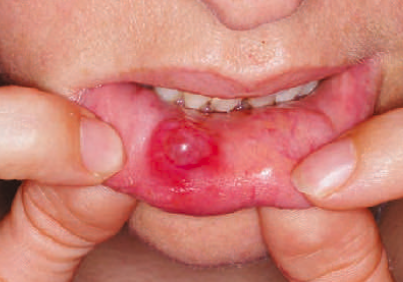 <p>found on the lower lip</p><p>the common clinical term for mucous extravasation phenomenon</p><p>occurs when <span style="color: red;"><span>saliva is retained inside the duct</span></span>, gland, or surrounding tissue spaces</p>