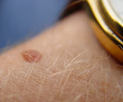 <p>solid, elevated lesion with <strong>no visible fluid</strong></p><p>may be up to 1/2cm in diameter</p>