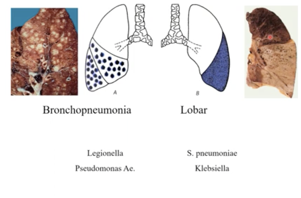 Bronchopneumonia → when the bacteria go into the bronchioles and alveoli and eat at the tissue (can be seen outside the lung 

Lobar → the whole lobe is filled with bacteria 