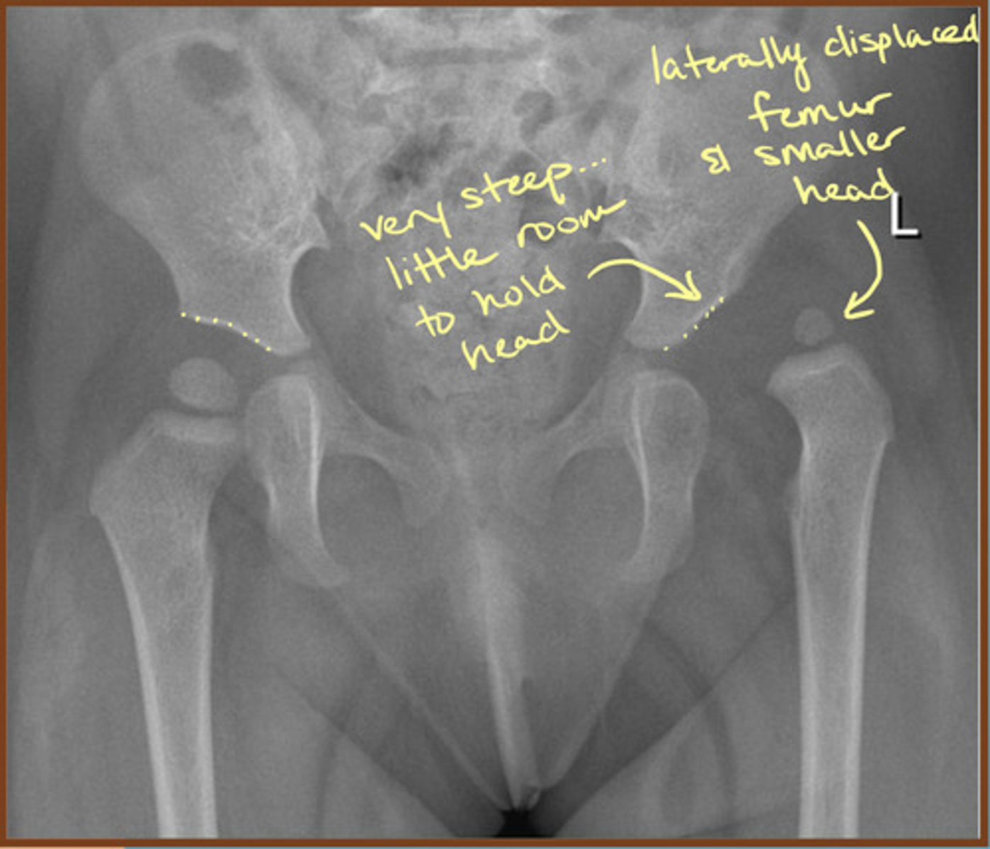 <p>Aberrant development of the hip joint, resulting from an abnormal relationship of the femoral head to the acetabulum</p><p>Usually occurs from ligamentous laxity and abnormal position in utero</p>