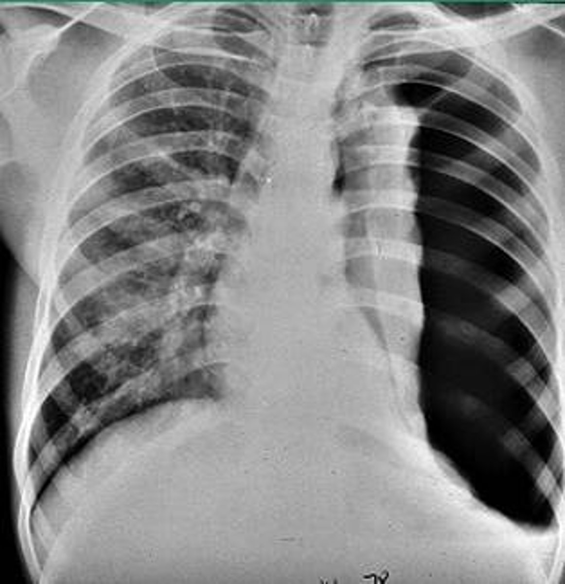 <p>air in the pleural cavity caused by a puncture of the lung or chest wall</p>