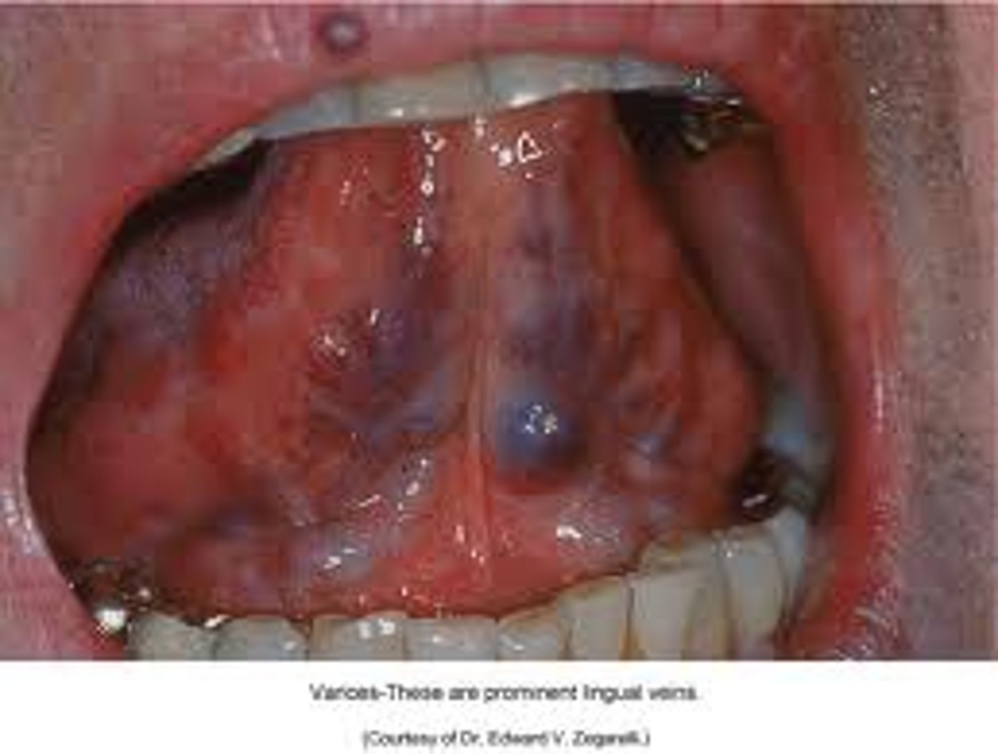 <p>• Abnormally dilated and tortuous</p><p>veins</p><p>• Age is an important etiologic</p><p>factor</p>