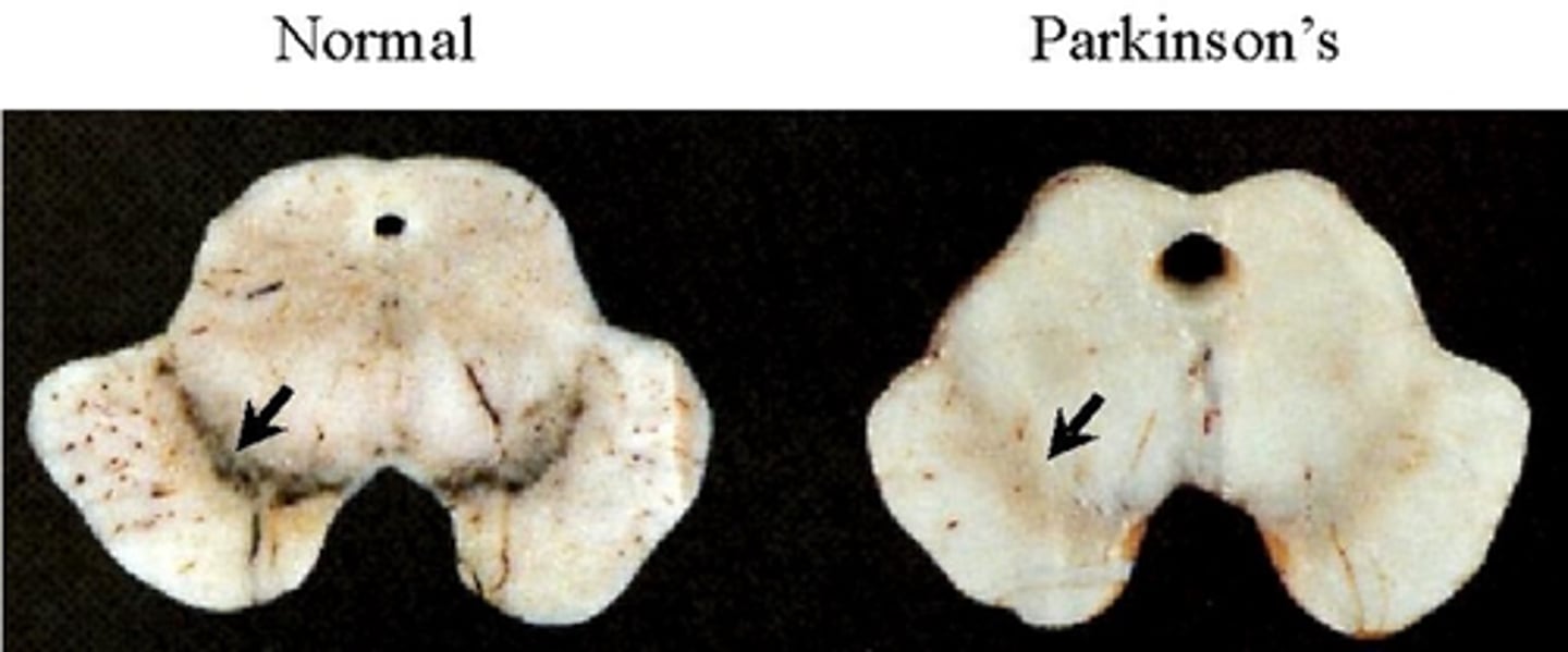 <p>Loss of dopamine in PD patients is due to what?</p>