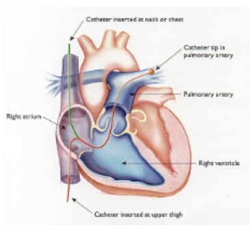 <p>Swan-Ganz catheter</p><ul><li><p>inserted into vein and pushed to entrance to right atrium</p></li><li><p>balloon at tip is inflated so that flow of blood carries catheter into atrium, right ventricle, and pulmonary artery</p></li><li><p>catheter tip advanced into pulmonary circulation until it wedges in a small vessel</p></li><li><p>forward flow of blood in that vessel is blocked and transducer detects “pulmonary wedge pressure” (good indicator of left atrial pressure)</p></li></ul><p></p>