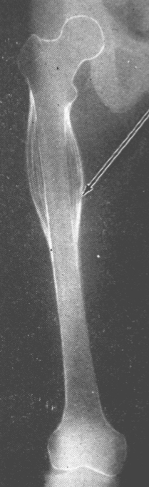 <p>Multiple layers of concentric layers of periosteal new bone formation seen in ewings sarcoma</p>