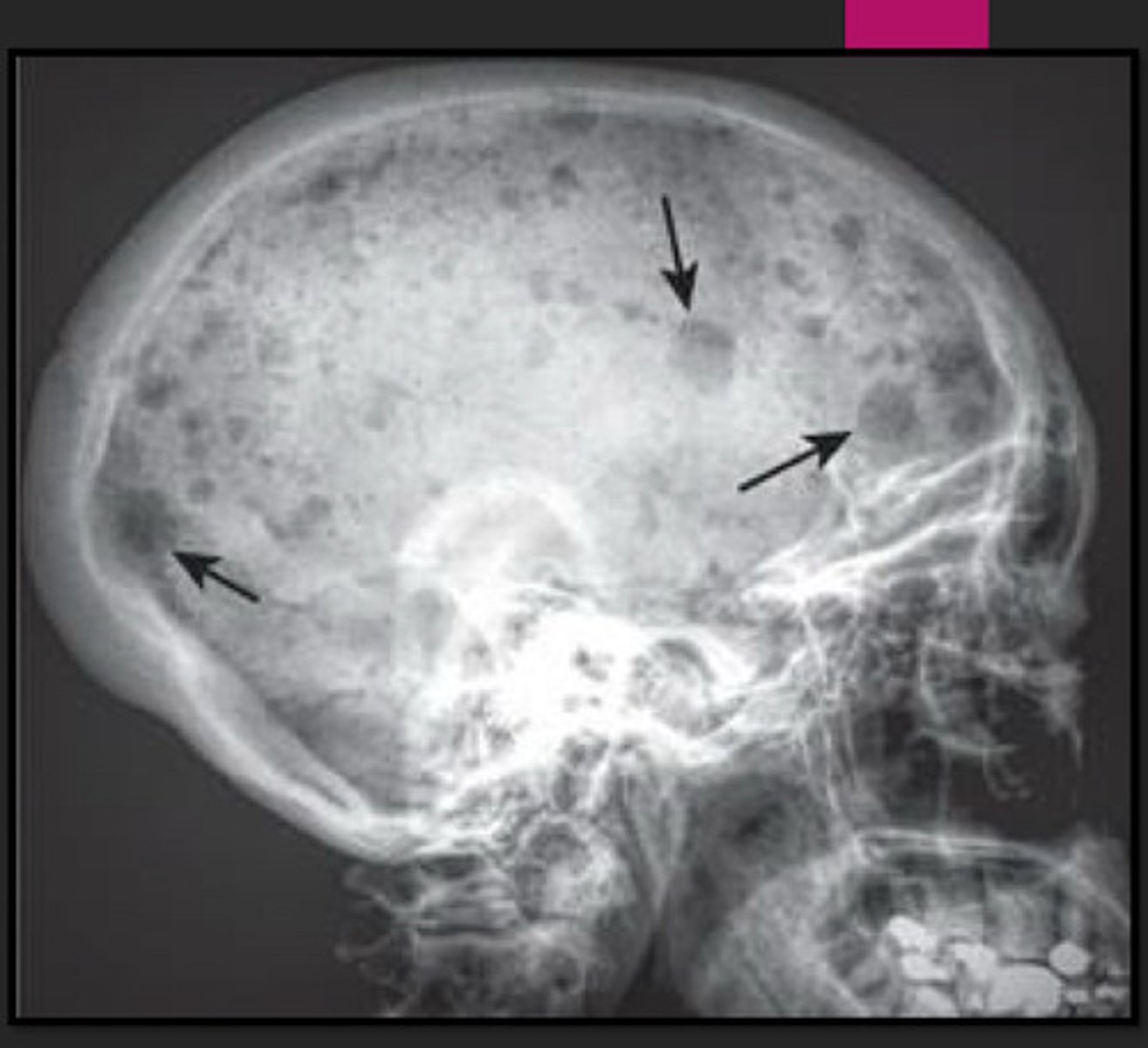 <p>multiple, small sharply circumscribed (described as "punched out") lytic lesions of approx the same size</p>