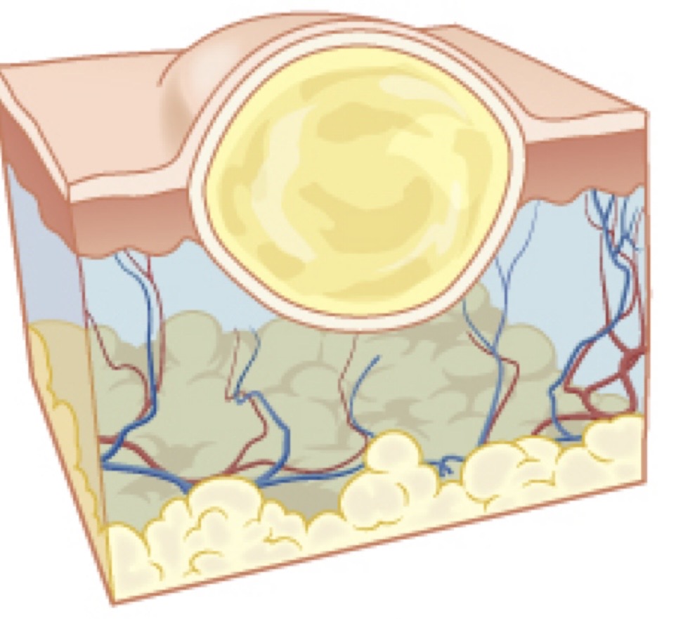 <p>Bumps on the skin filled with fluid or pus</p><p>In acne</p><p>Can be red at the base</p>