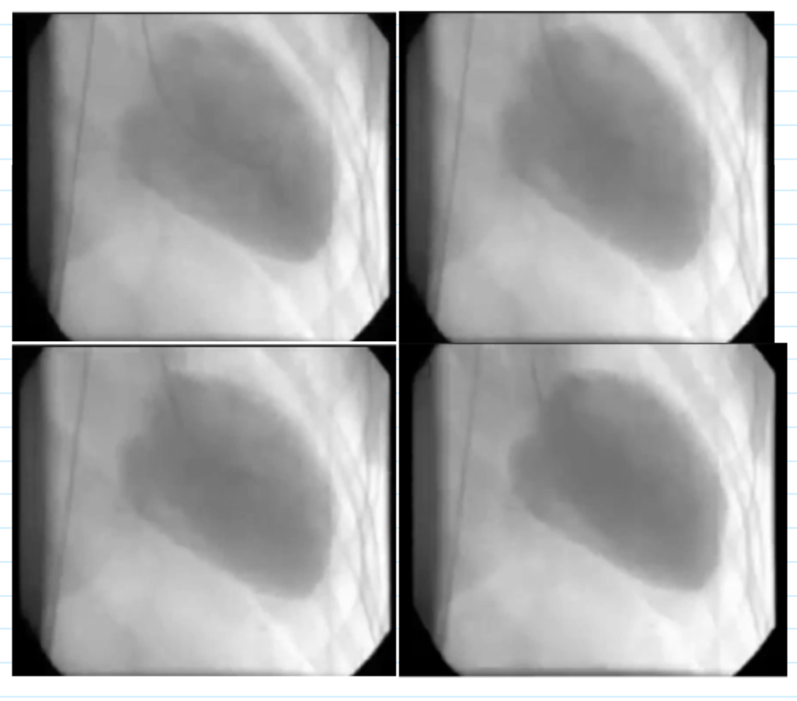 <ul><li><p>projection</p></li><li><p>Wall motion assessment</p></li><li><p>Estimated ejection fraction</p></li><li><p>Any valvular disease visualized</p></li></ul><p></p>