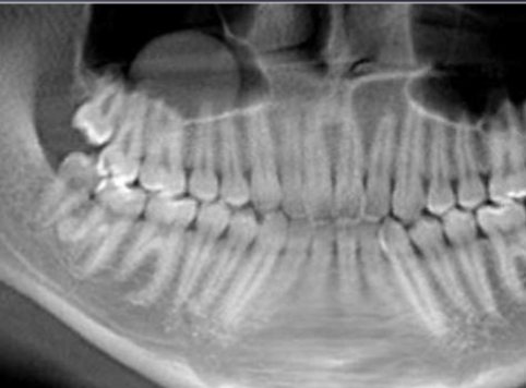 <p>dome shaped, faintly radiopaque lesions arising from maxillary sinus </p>