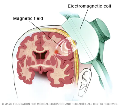 <p>briefly turns off part of brain using magnetic field coil to study what happens when there are deficits - makes “virtual lesions”</p><ul><li><p>disrupting voltage firing of local cells - magnetic pulses stimulates the nerve cells</p></li><li><p>influences brain activity</p></li></ul><p></p>