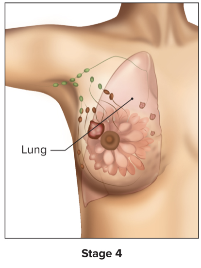 <p>Cancer is detectable in distant tissues outside originating area</p>