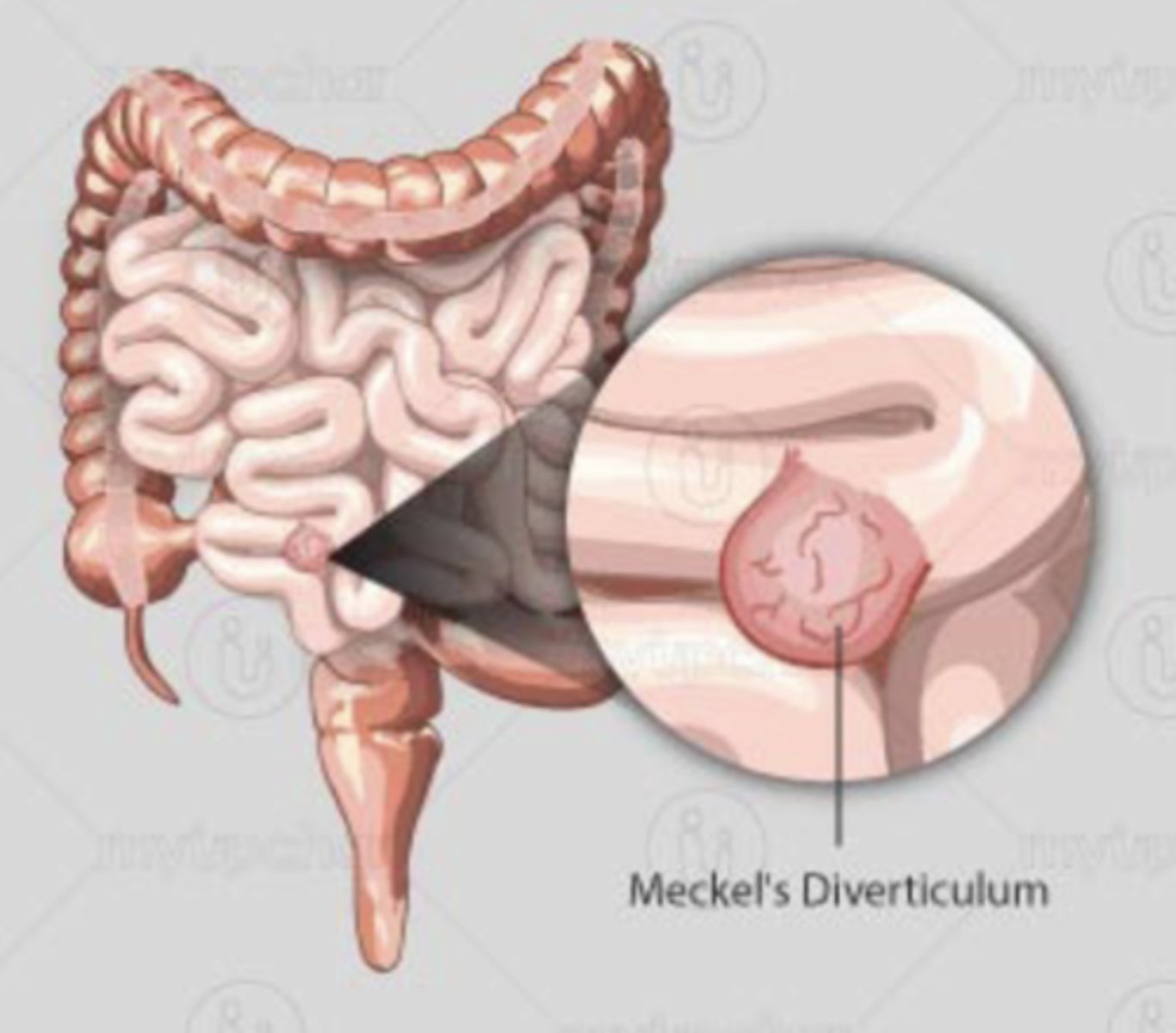 <p>- Outpouching of ileum 50-75 cm of ileocecal valve</p><p>- Congenital disorder resulting from persistence of embryonic vitelline duct</p><p>- Mimics pain of appendicitis</p><p>- Rule of 2's: 2% of children, 2 years of age, 2 feet from ileocecal valve, 2 types of mucosa</p>