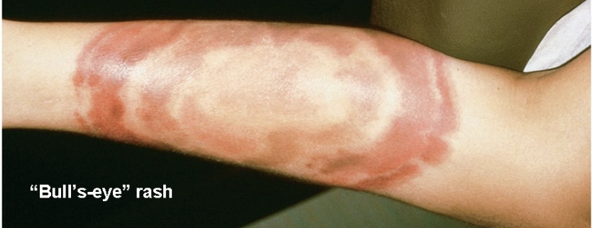 <ul><li><p class=""><strong>Bull’s-eye rash</strong> (erythema migrans) in 50–70% of cases</p></li><li><p class="">Fever, headache, stiff neck, dizziness</p></li></ul><p></p>