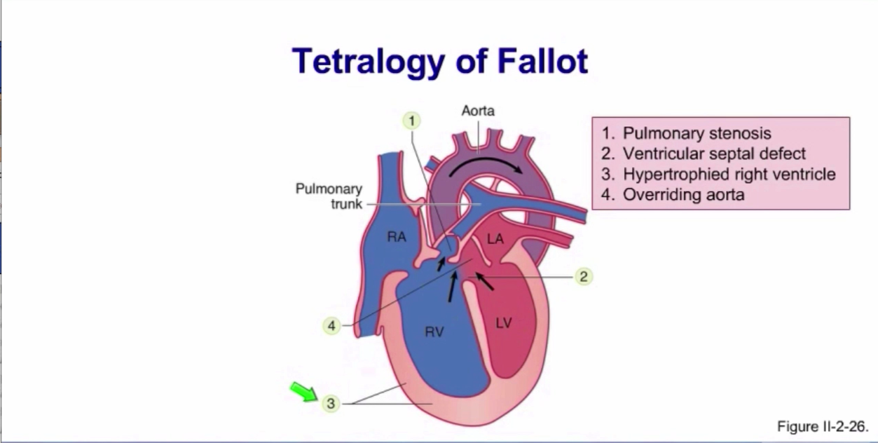<ol><li><p>Truncus arteriosus (no APS)</p></li><li><p>Tetralogy of Fallot ( APS more on the right side)</p></li><li><p>Transposition of great vessels (does not goes spiral)</p></li></ol><p></p>