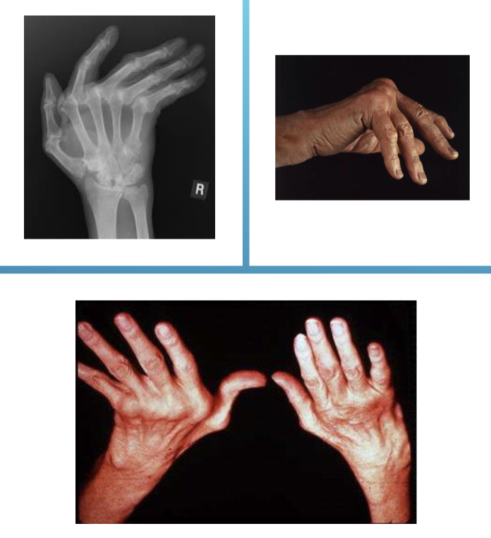 <ul><li><p>wrist will deviate radially&nbsp;</p></li><li><p>fingers will deviate ulnarly</p></li><li><p>may include finger deformities</p></li><li><p>‘windswept fingers’</p></li></ul><p></p>