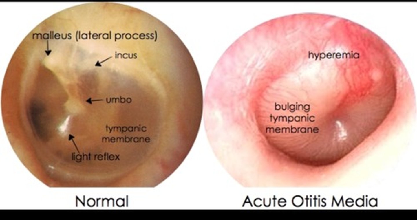 <p>infection of the middle ear</p>