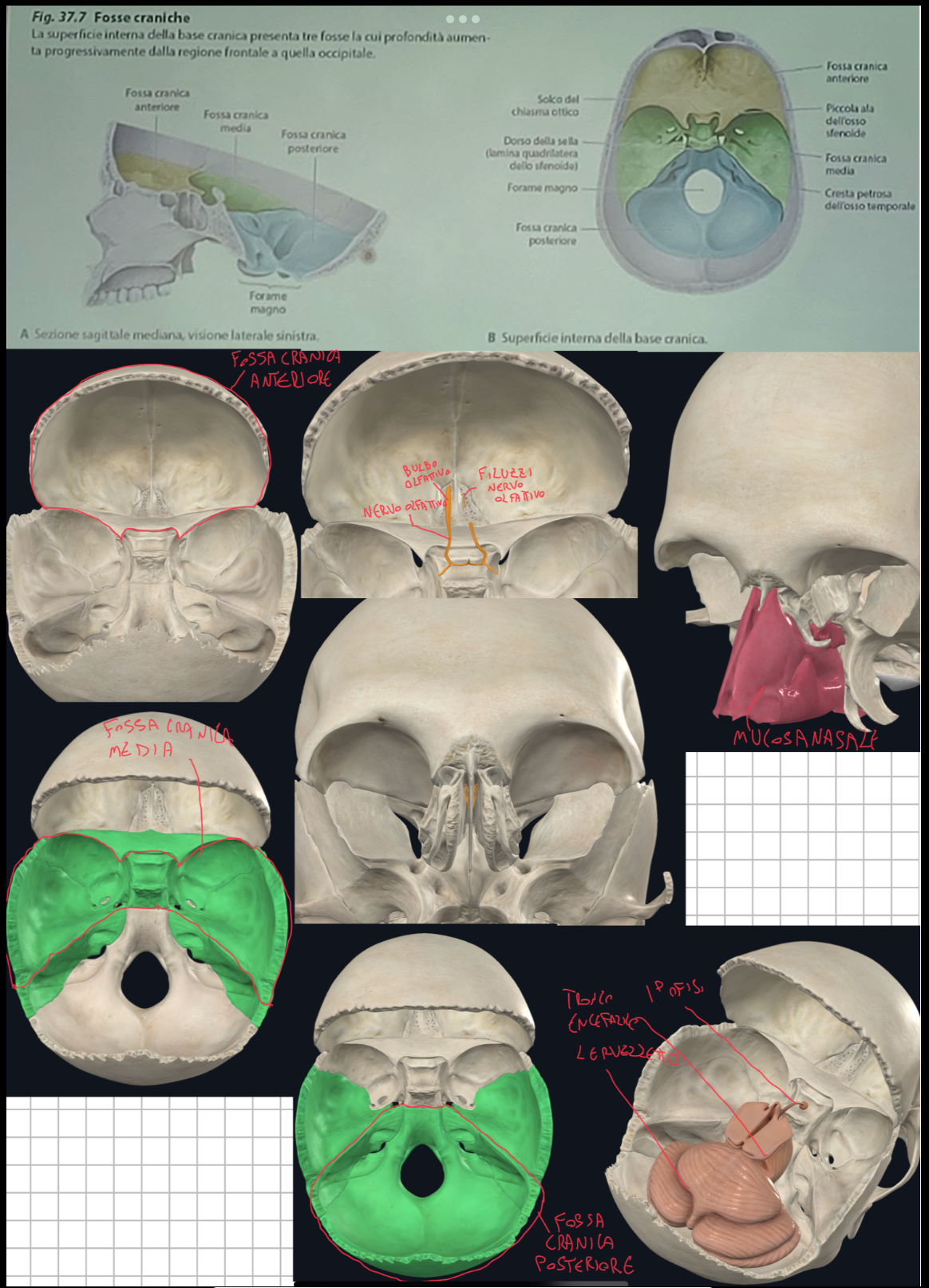 <p>Distinguiamo tre zone che delimitano le 3 fosse craniche</p><p>Fossa Cranica Anteriore, delimitata da:</p><ul><li><p>Osso Frontale (porzione orbitaria)</p></li><li><p>Lamina cribrosa dell’Etmoide</p></li><li><p>Piccole ali dello Sfenoide</p></li><li><p>Il suo pavimento rappresenta il tetto delle cavità nasali</p></li><li><p>Contiene i lobi frontali</p></li></ul><p>Fossa Cranica Media, delimitata da:</p><ul><li><p>Corpo e Grandi ali dello Sfenoide</p></li><li><p>Parte anteriore petrosa dei Temporali</p></li><li><p>Contiene i lobi temporali, ipofisi e lobi mediali degli emisferi cerebrali</p></li></ul><p>Parte Posteriore:</p><ul><li><p>Osso Occipitale</p></li><li><p>Parte posteriore petrosa dei Temporali</p></li><li><p>Clivo dello Sfenoide</p></li></ul><ul><li><p>Contiene il cervelletto e tronco encefalico</p></li></ul><p></p><p>N.B.</p><p>Le fosse non sono sullo stesso piano:</p><ul><li><p>l’anteriore è più alta, segue la media e poi la posteriore</p></li></ul><p></p><p></p>